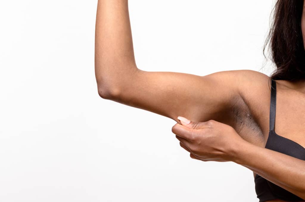 Arm Lift Surgery in Leawood KS
