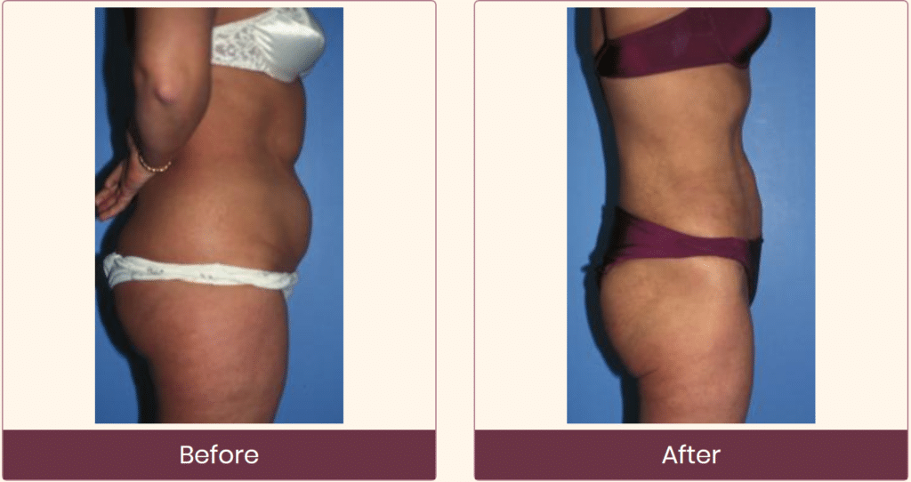 liposuction before and after gallery - Dr Cusick
