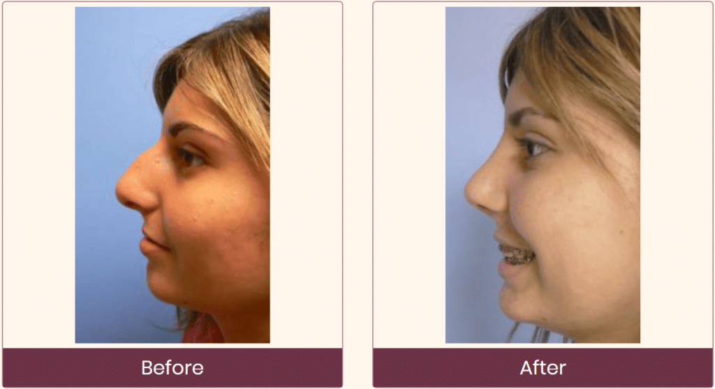 Before and After Nose Surgery - Dr Cusick