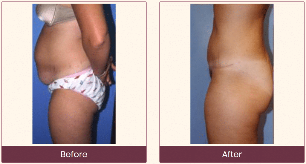 before and after mommy makeover tummy tuck